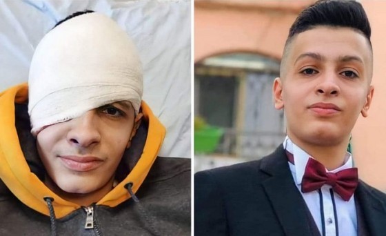 الاحتلال يتعمّد إحداث إعاقات ..هذا ما فعلته رصاصة "إسرائيلية" بعين طفل في مُخيّم قلنديا