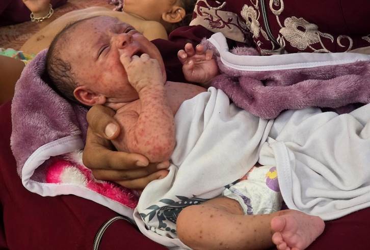 تحذيرات من انتشار جدري الماء بين النازحين في جنوب غزة وسط انهيار الأوضاع الصحية